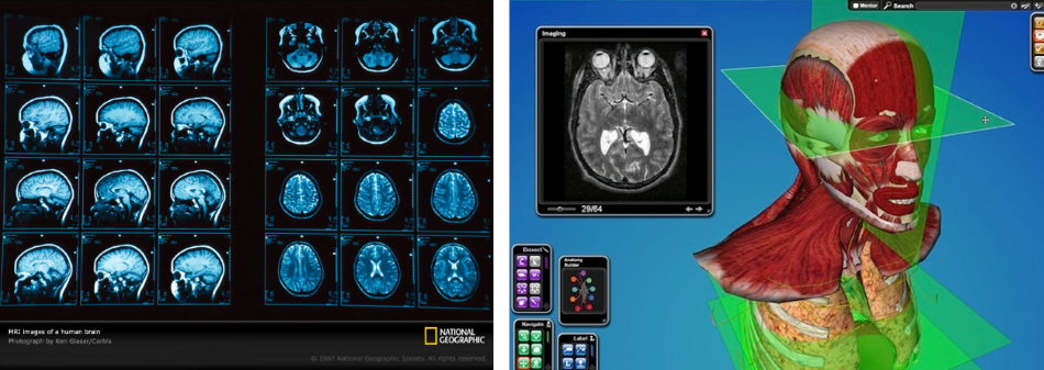 The standard MRI output (left) vs. the zSpace model of the same data (right)